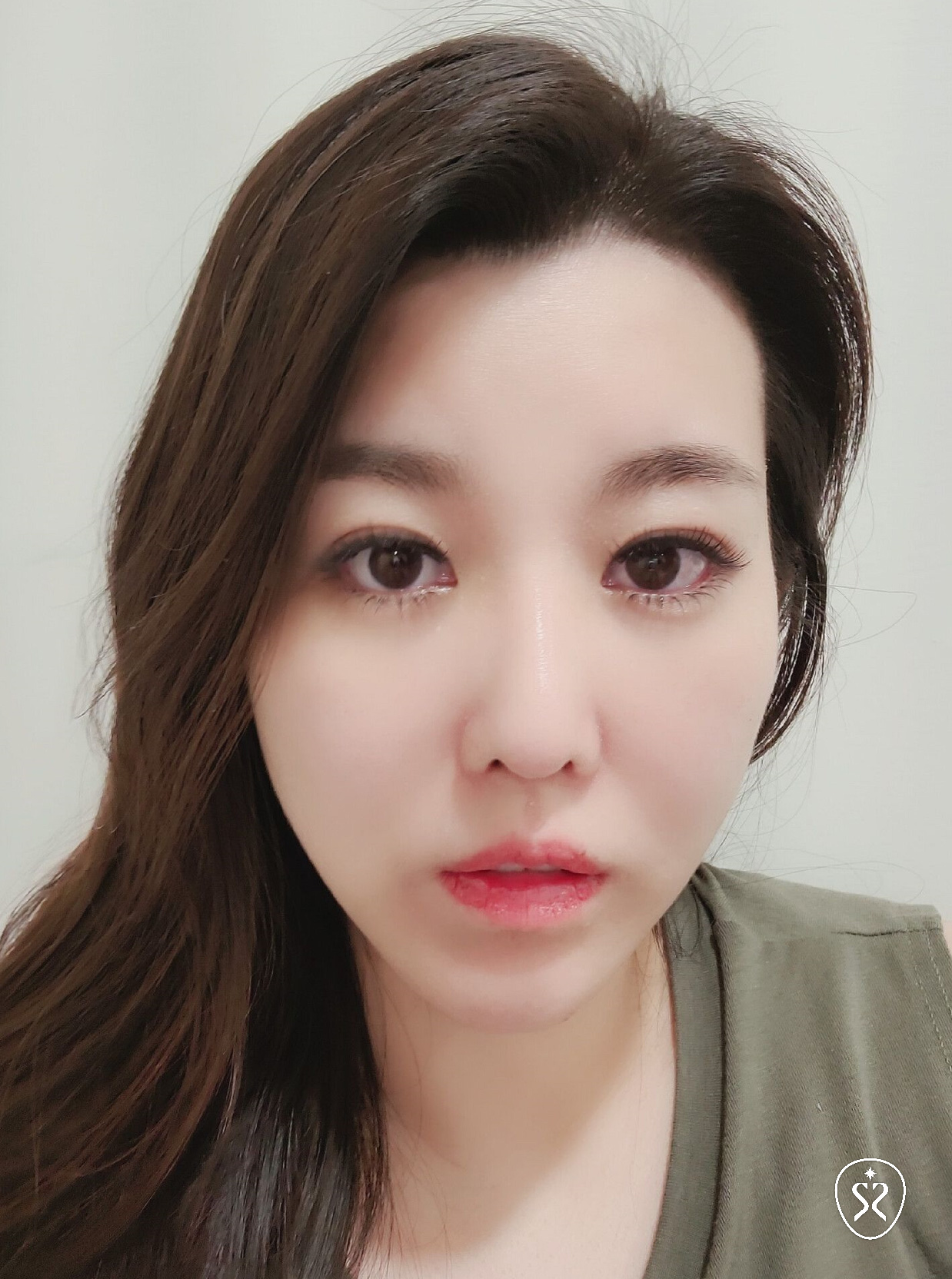 術後恢復期腫脹與凹凸不平屬正常現象